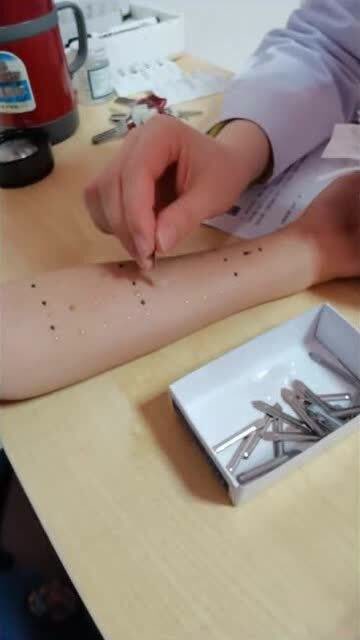 医生正在用点刺法查过敏源我曾经也这样查过