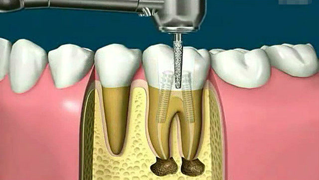 看完这个根管治疗牙髓炎视频后,吓得我赶紧去刷牙