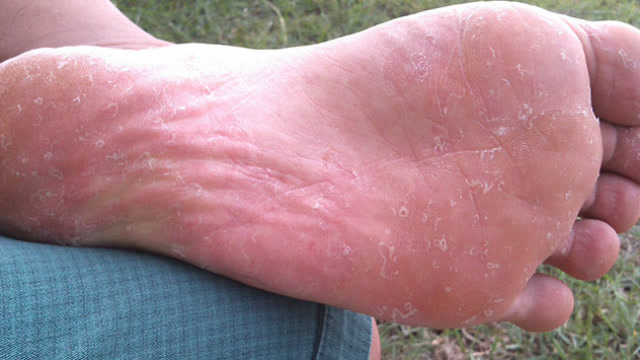 脚底脱皮是怎么回事不仅仅是真菌感染