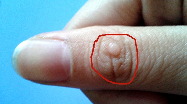 皮肤无缘无故长出小肉疙瘩,是患上了什么皮肤病吗?