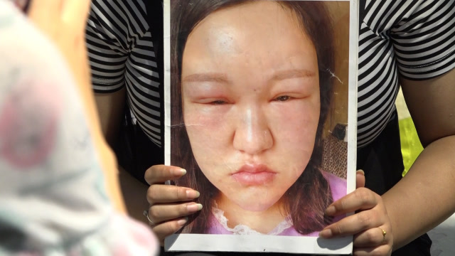 河北女子注射玻尿酸后全脸肿胀:本想变美,结果成这"鬼样子"