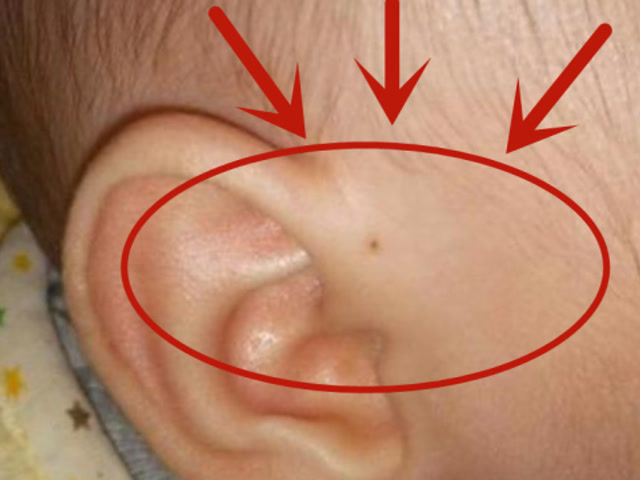 为什么新生儿耳朵上有"小洞"?医生一般不说,家长心里要有数!