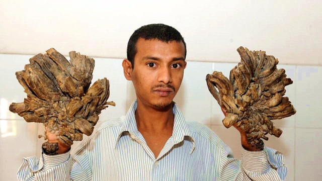 男子身患怪病,手脚上长出"树根",被当地人称为"树人"!