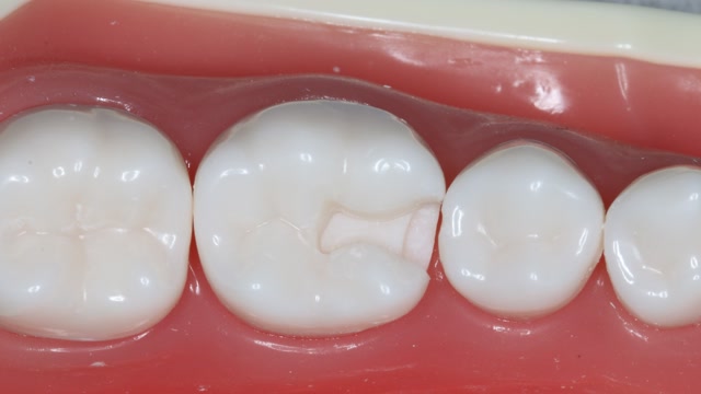 36仿真牙ii类洞制备-牙体牙髓病学实验4-2