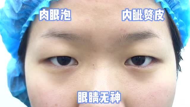 肉眼泡 内眦赘皮 眼睛无神的姑娘 半年后眼睛大了一圈