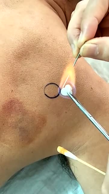 毫火针治疗肩周炎2