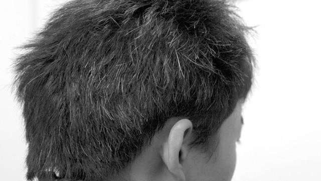 早年白发原来也叫病理性白发