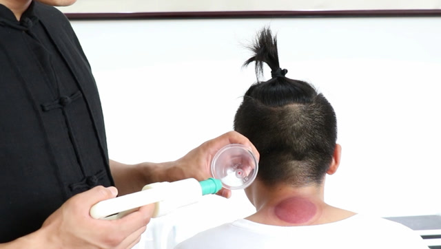 颈椎不好快给你的颈椎拔罐简单实用颈椎不再痛