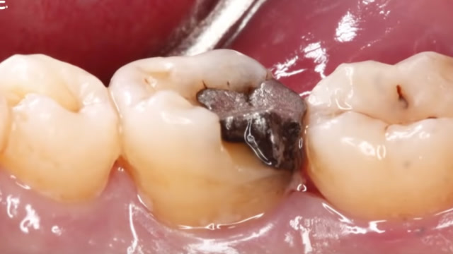 超级大蛀牙修补过程看的好难受看完再也不吃糖了