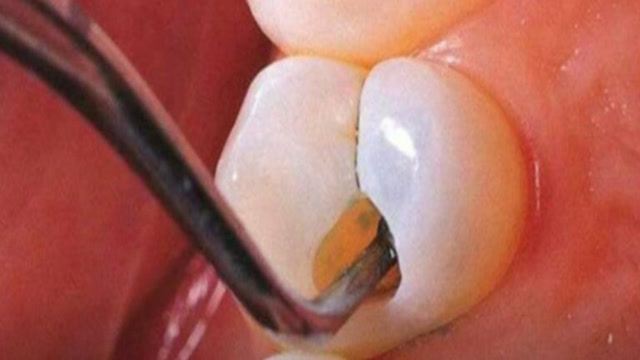蛀牙到底是如何形成的?真是因为牙虫啃咬吃空吗?原因令人惊讶