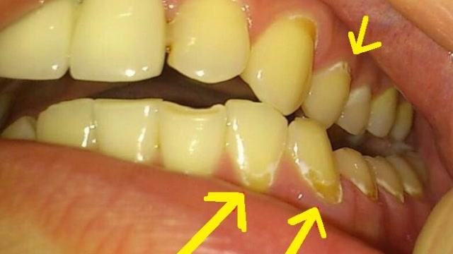 牙结石"又臭又硬"怎样去除?一个土方法,牙垢唰唰往下掉!