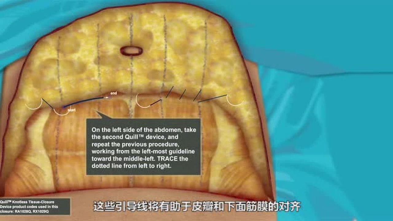 快翎手术操作视频-腹壁成形术