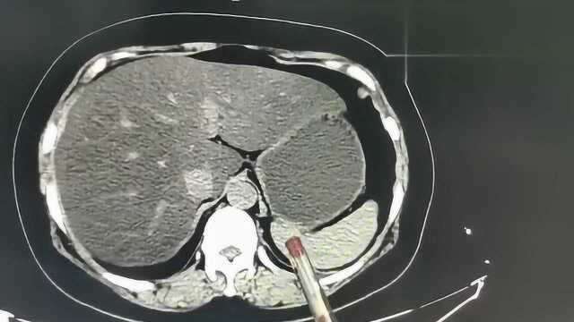 一位重度脂肪肝患者的CT图像