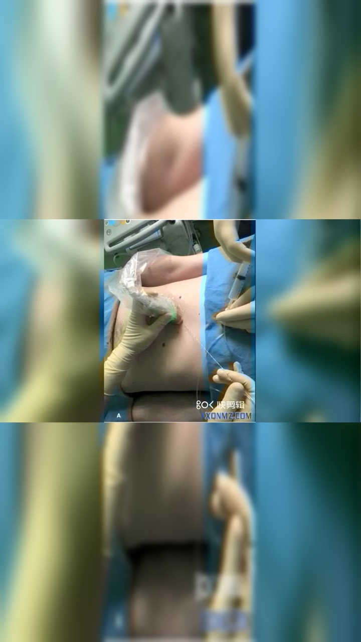 超声引导肋缘下腹直肌鞘阻滞（厦门大学附属中山医院柴彬）_高清