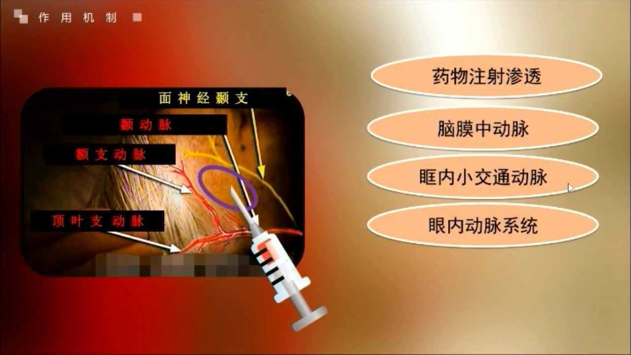 颞浅动脉旁皮下注射