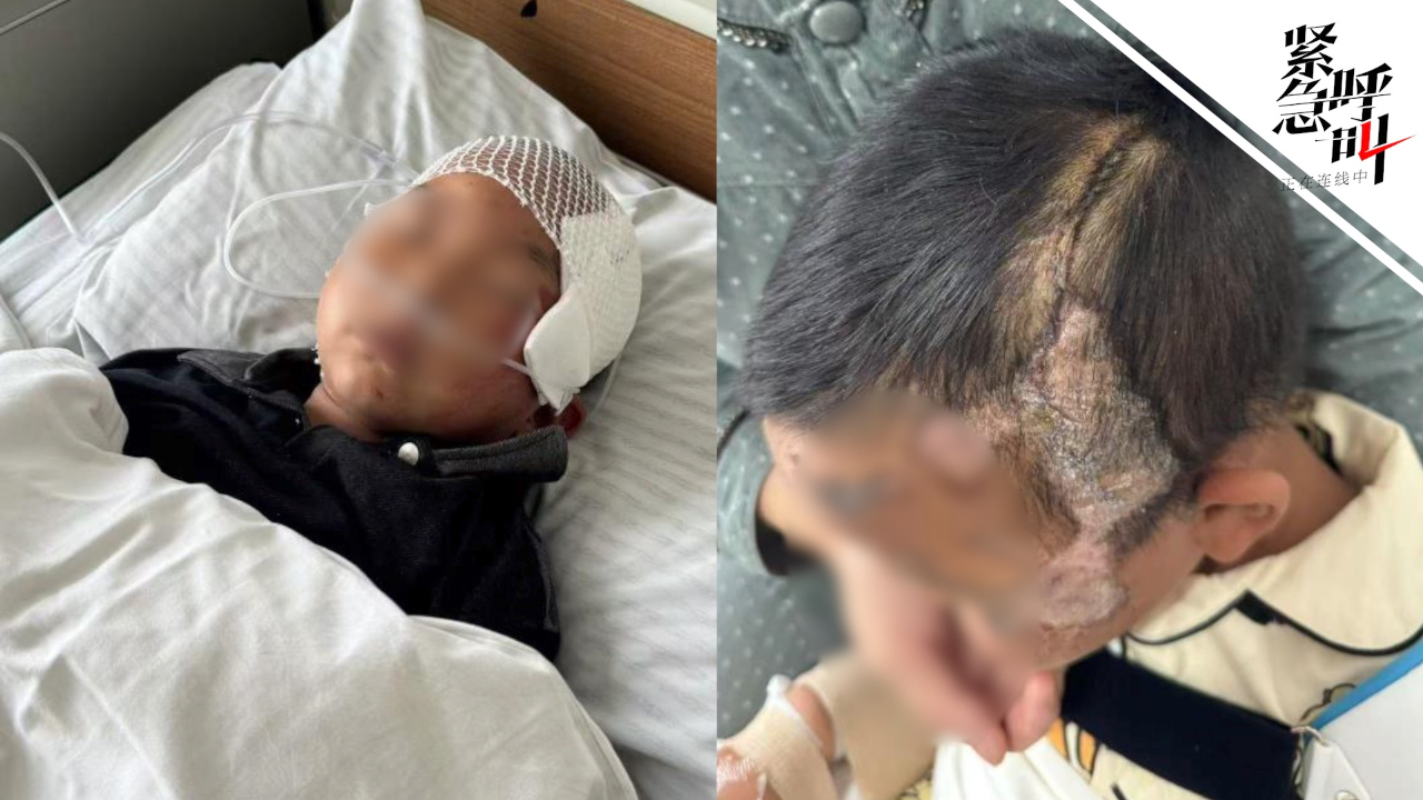 6岁男童在校内被送餐车碾压,孩子父亲:身上多处骨折,内脏受损,头缝30