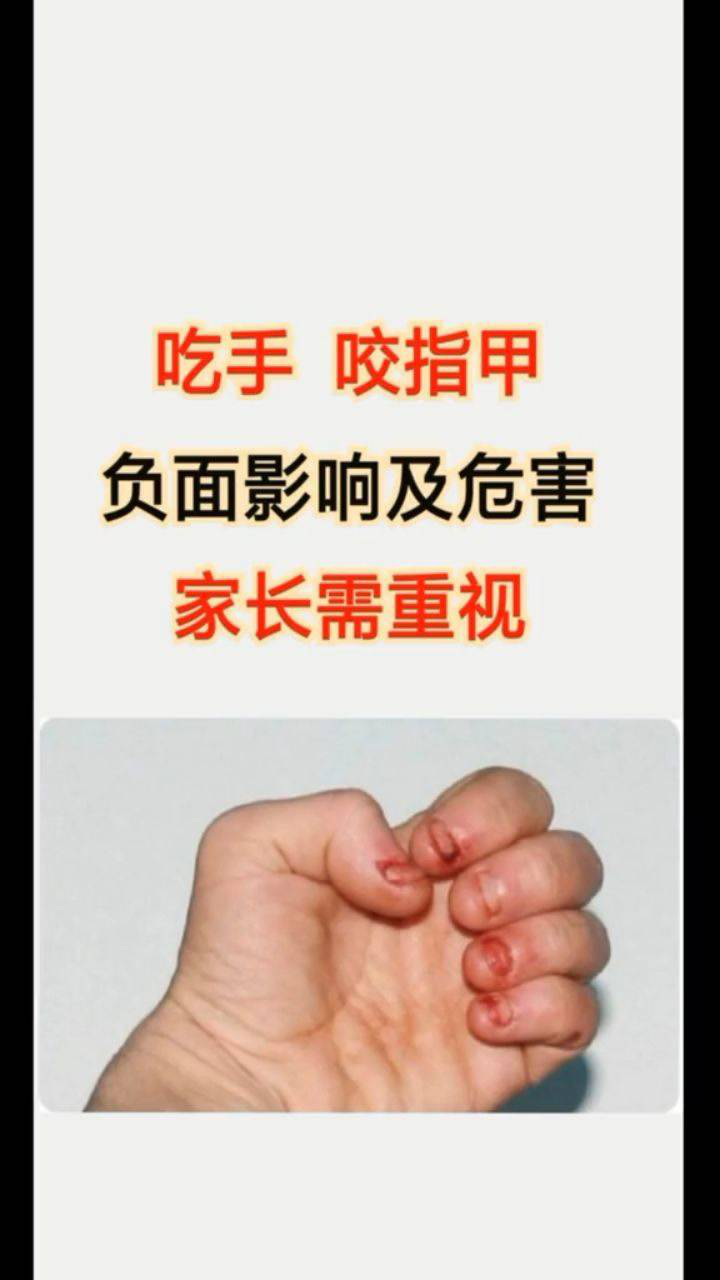 吃手咬指甲负面影响及危害家长需重视