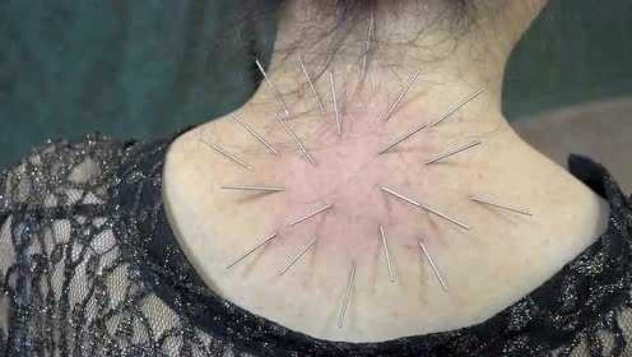 解晓丽针灸治疗富贵包手法实操