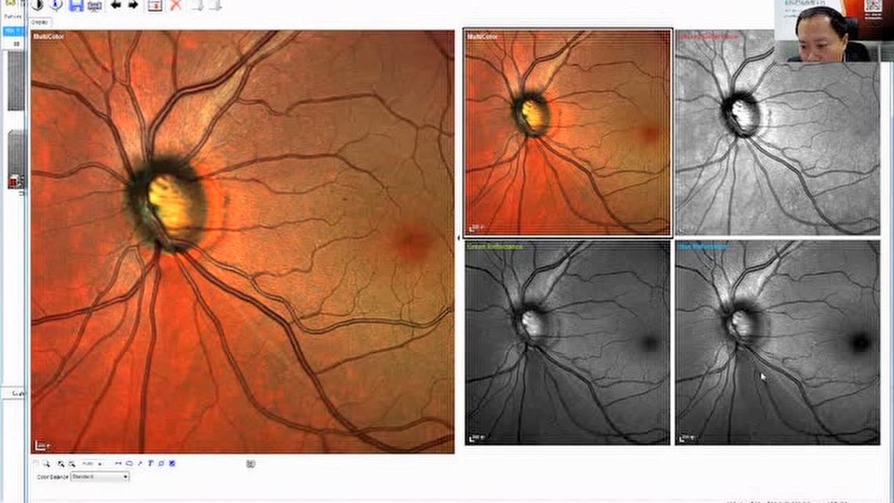 海德堡血流oct应用工场之青光眼-王敏教授