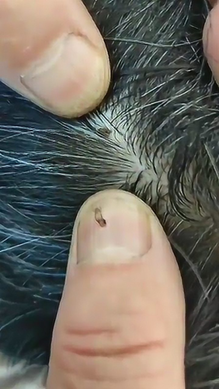 虱子多了 腾讯网