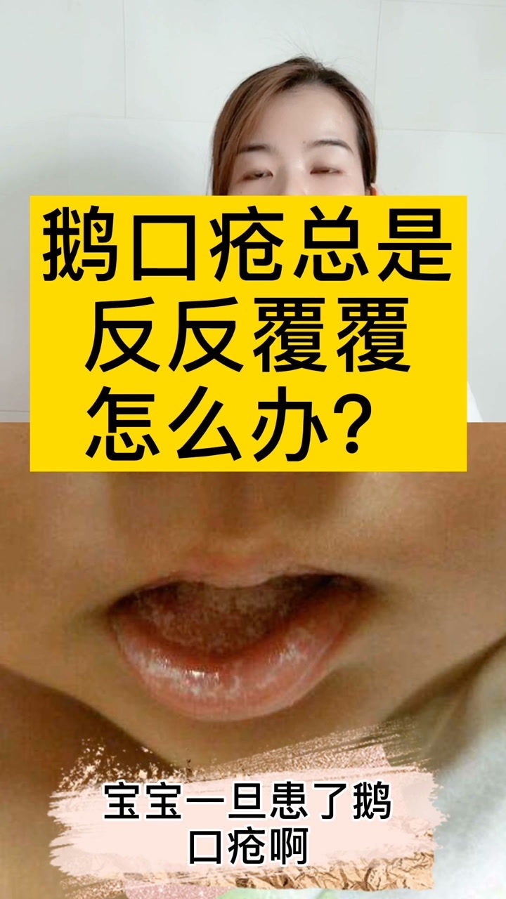 鹅口疮总是反反覆覆怎么办?