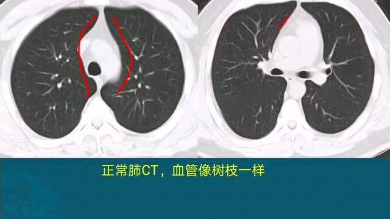 CT片上，怎样看肺结节？医生教你1个技巧，2分钟学会_高清