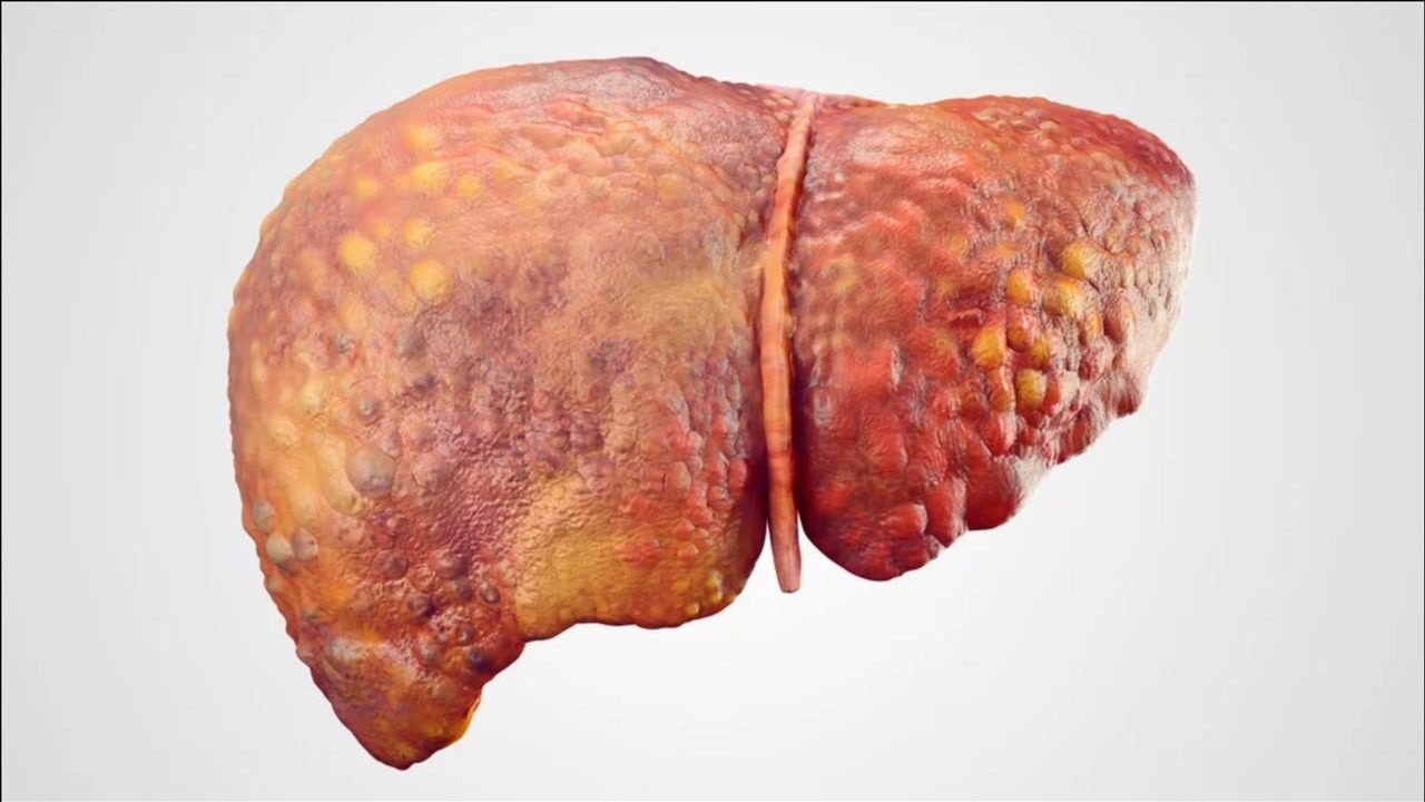 医生坦言:戒酒是治愈酒精肝的前提