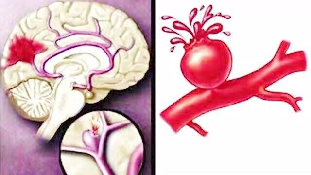 冬季脑卒中预防与急救(辽阳辽化医院)