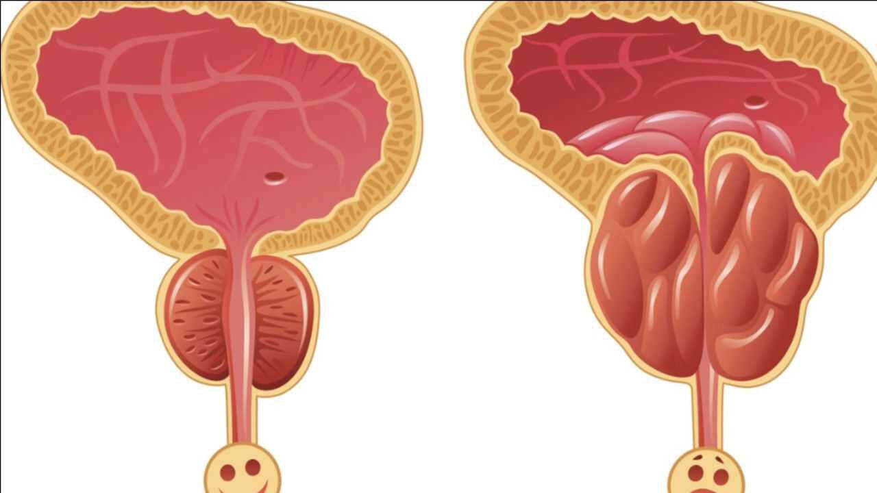 男性为什么会得膀胱结石?3大因素是主凶,劝你小心预防