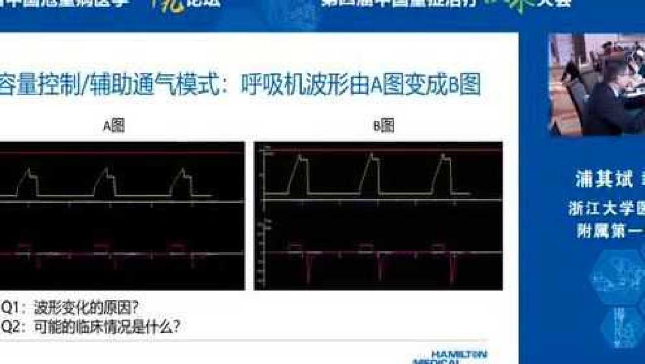 呼吸机波形分析-浙大一浦其斌_腾讯视频