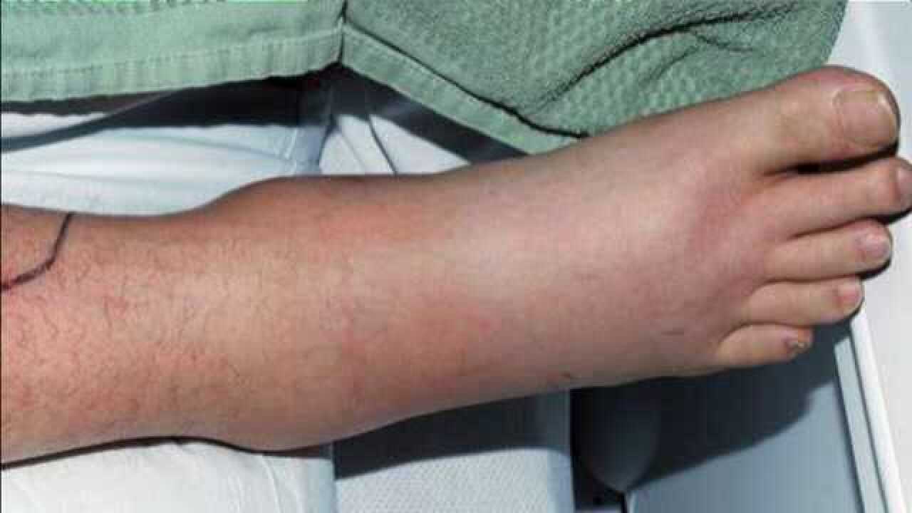 糖尿病足早期症状:下肢有这3个异样,都在提醒你血糖高了