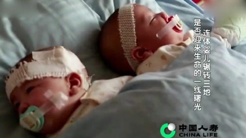 生命缘：求子7年竟产下连体婴儿，双胞胎姐妹共用一个肛门！