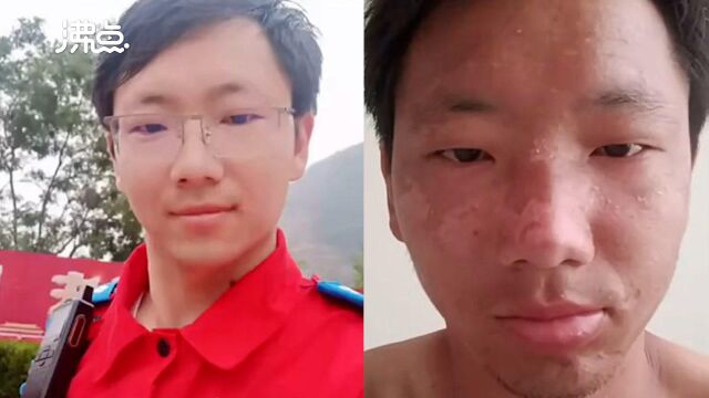 新乡男子晒抗洪前后照片对比:白俊小生被晒到满脸黝黑脱皮 连朋友都认不出了