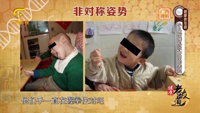 小儿脑瘫要如何治疗?医生分享几种常见的康复治疗方法