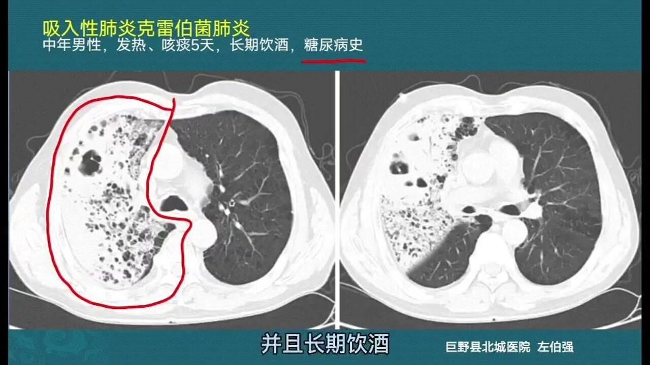 肺炎桿菌(KPC)