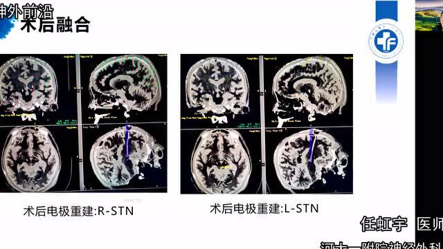 美敦力DBS特刊 | 专访河大一附院何承 任虹宇:毁损后复发的帕金森病患者 DBS治疗的探索与经验