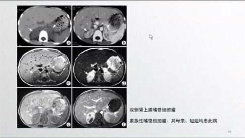 嗜铬细胞瘤和副神经节瘤_天津医科大学总医院孙浩然