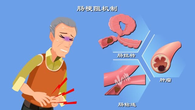 拉不出屎背后真相是啥?肠梗阻发病机制动漫版!