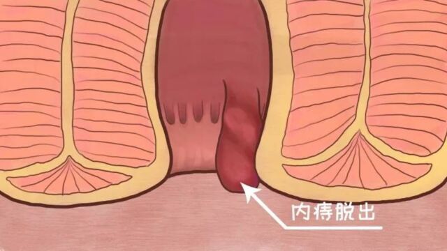 痔疮的治疗方法有哪些?三种方法让你摆脱痔疮折磨!