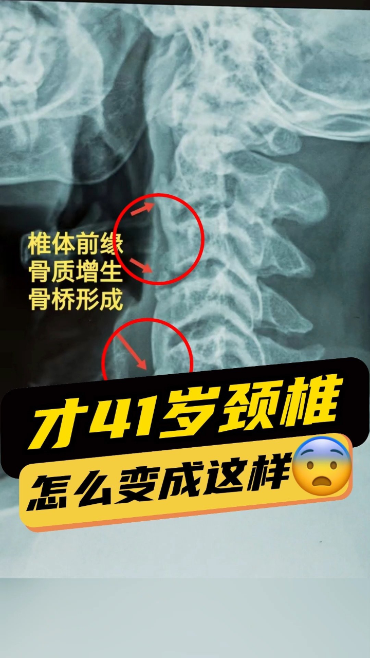 颈椎病真相揭秘!骨质增生是退行性改变,一般不会被消除.
