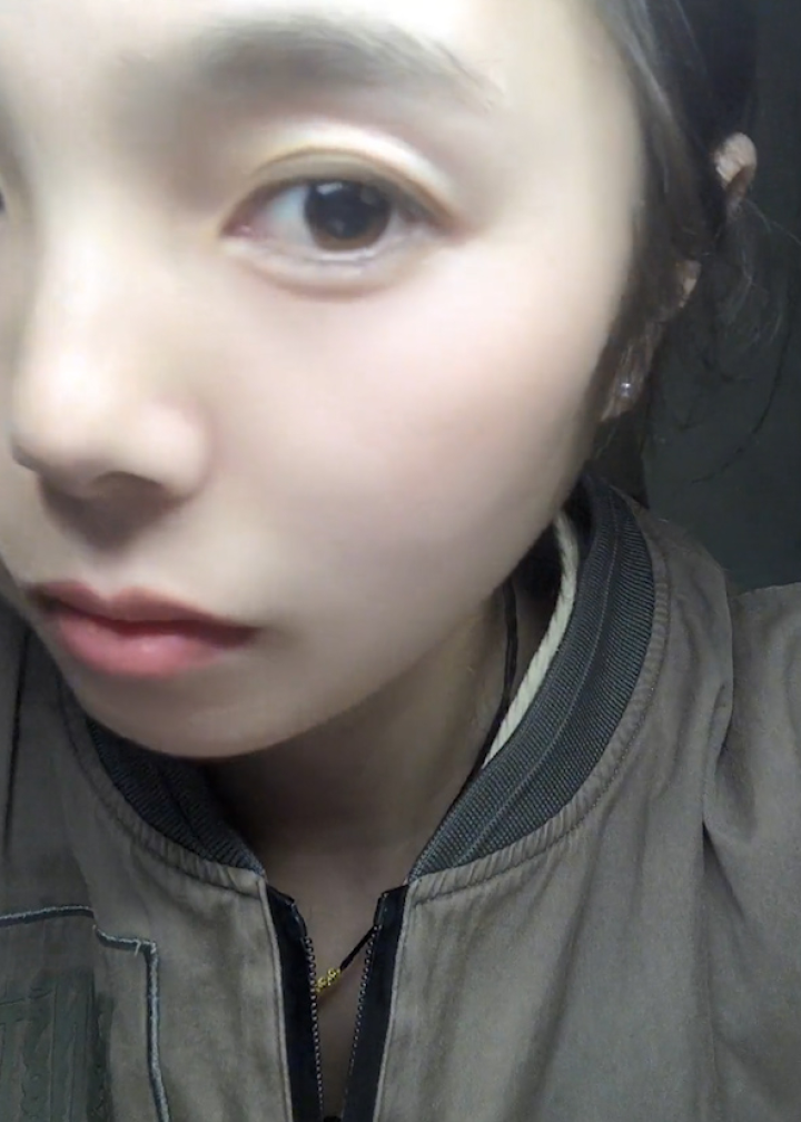 女子左眼瞳孔变大2倍找不到病因:白天不能出门,很畏光