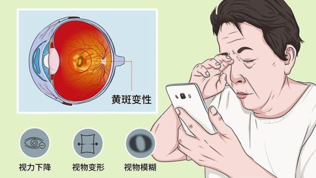 视力下降、看东西变形?警惕黄斑变性,日常保护最好做到这3点