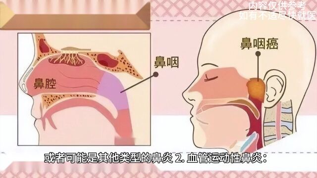 探秘慢性鼻炎:症状解读与鼻部健康维护指南