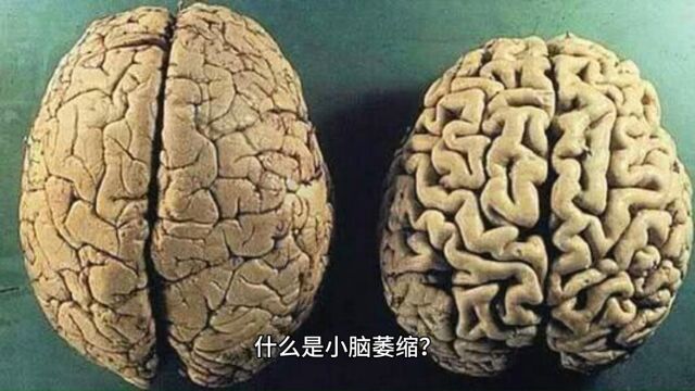 什么是小脑萎缩?