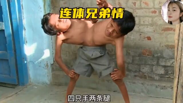 印度连体兄弟,两条腿四只手,奇迹存活长大想找对象,他们能成功吗