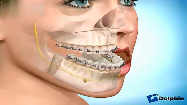地包天牙齿矫正手术过程看着都害怕