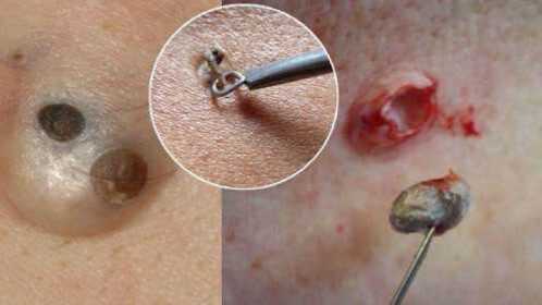 黑头堵塞毛孔易滋生螨虫只需涂点这个3天黑头螨虫全清除