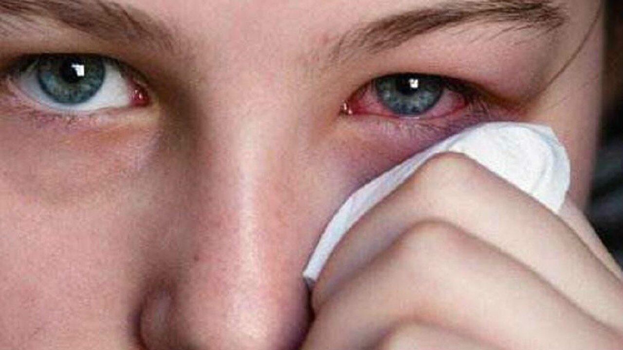 眼睛里进异物怎么办这才是正确的处理方法