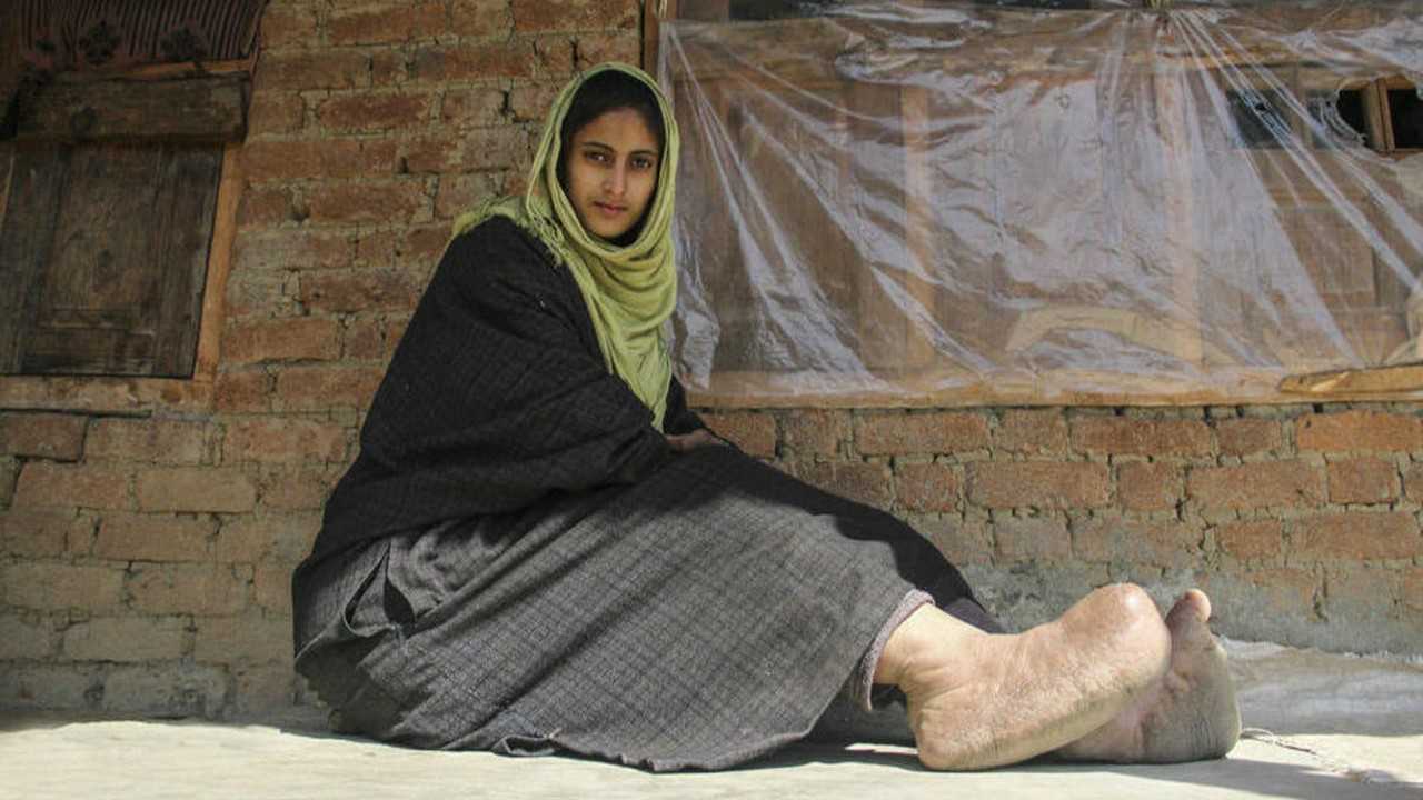 印度女孩患象皮病双脚长满寄生虫肿大如象腿穿不上鞋子