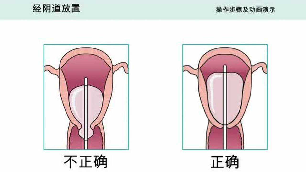 子宫填塞球囊操作_腾讯视频